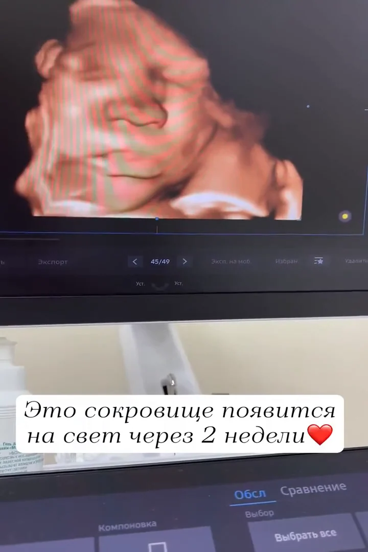 УЗИ 3D-4D: видео